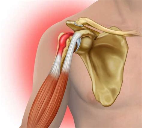 torn biceps tendon at shoulder